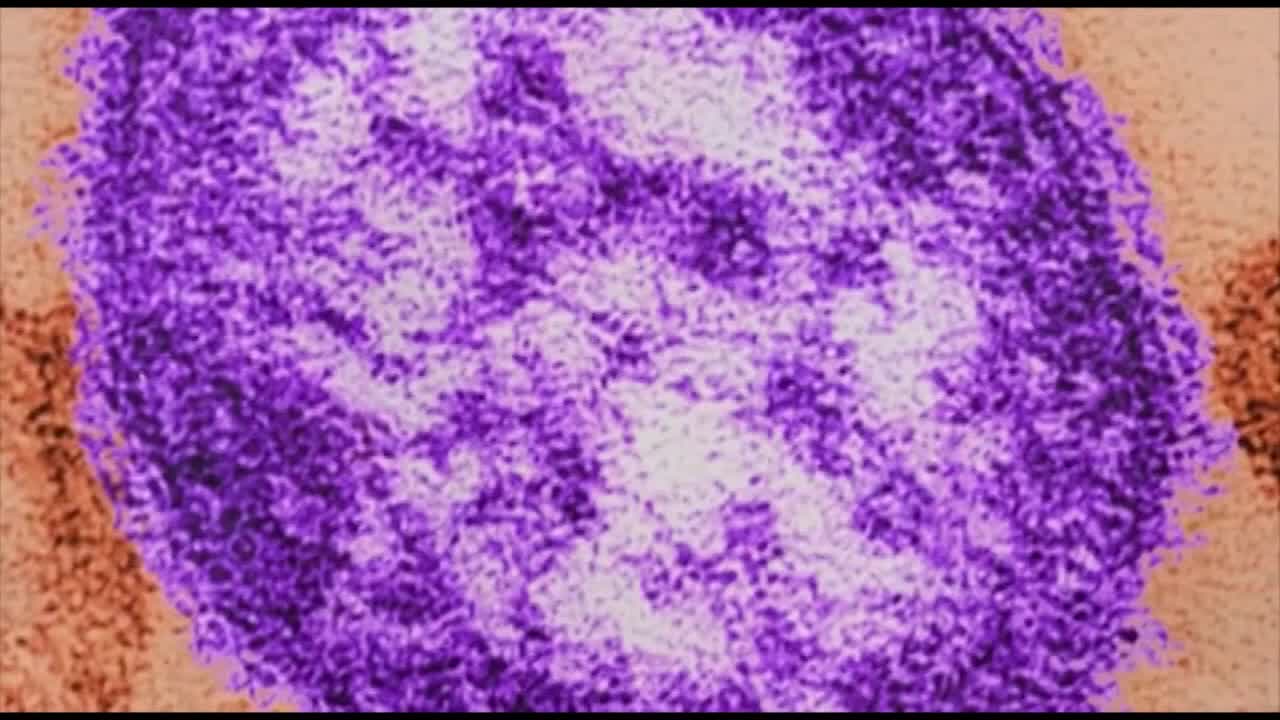 Chicago measles outbreak; Wisconsin continues to monitor cases – The Daily Guardia