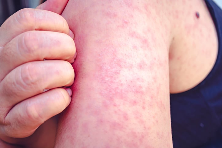 Alert: Multiple Measles Outbreaks in Wales – Insider Wales Sport