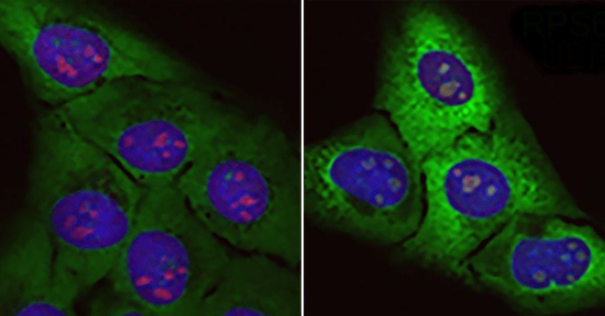 Nueva hipótesis sobre el origen de la ELA: la acumulación de proteínas basura