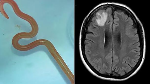 Photo of Encuentran un gusano vivo de 8 cm en el cerebro de una mujer australiana – Mr. Codigo