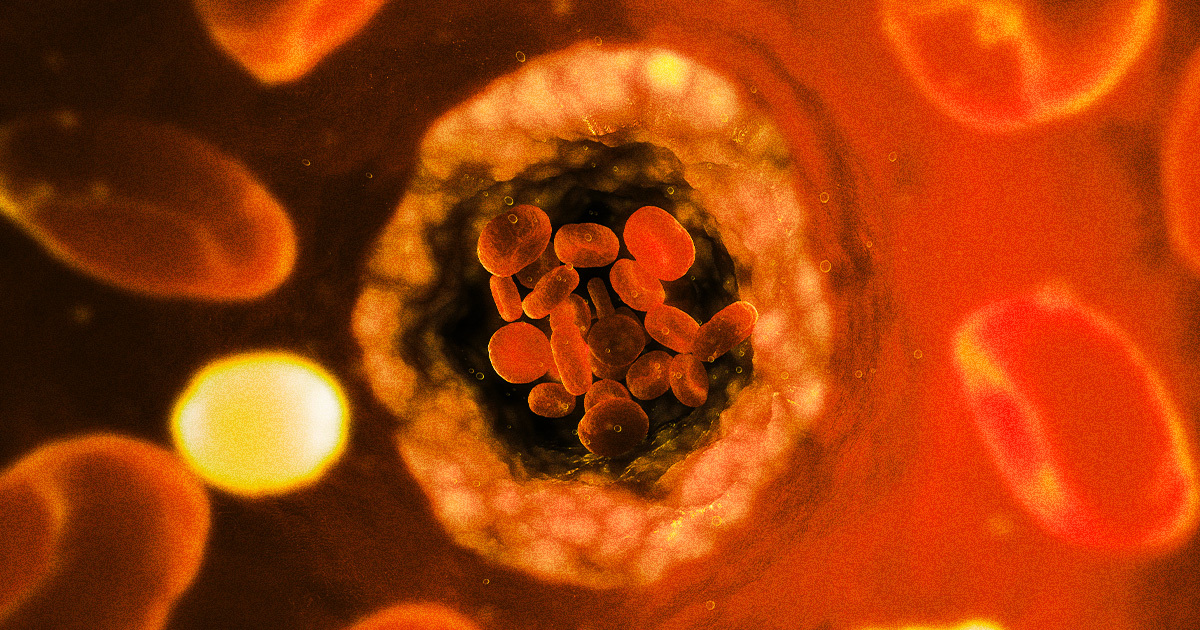 Microplastics Discovered Clogging Human Arteries