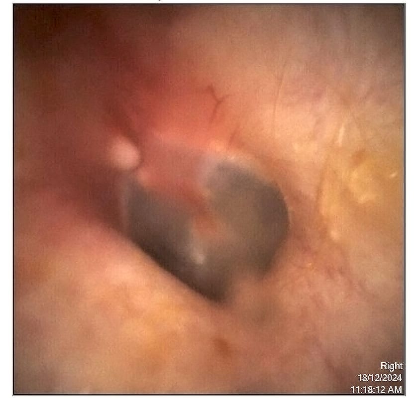  after wax removal paediatricchildrens hearing tests   the audiology place
