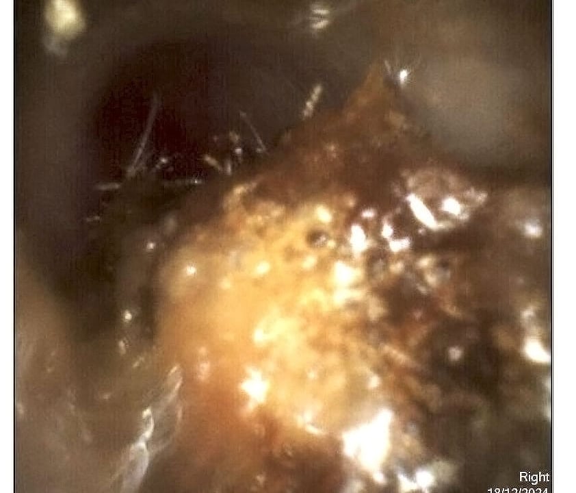  before wax removal when ear wax gets stuck your complete guide to safe removal   the audiology place