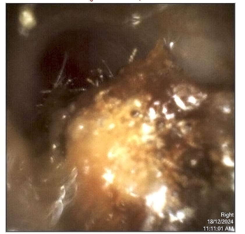 before wax removal in this image you can clearly see the ear canal is blocked with a large ball of wax the patient reported feeling blocked and sound was muffled the wax had built up inside the ear canal and was blocking access to the ear drum before wax removal ear wax removal before and after the audiology place