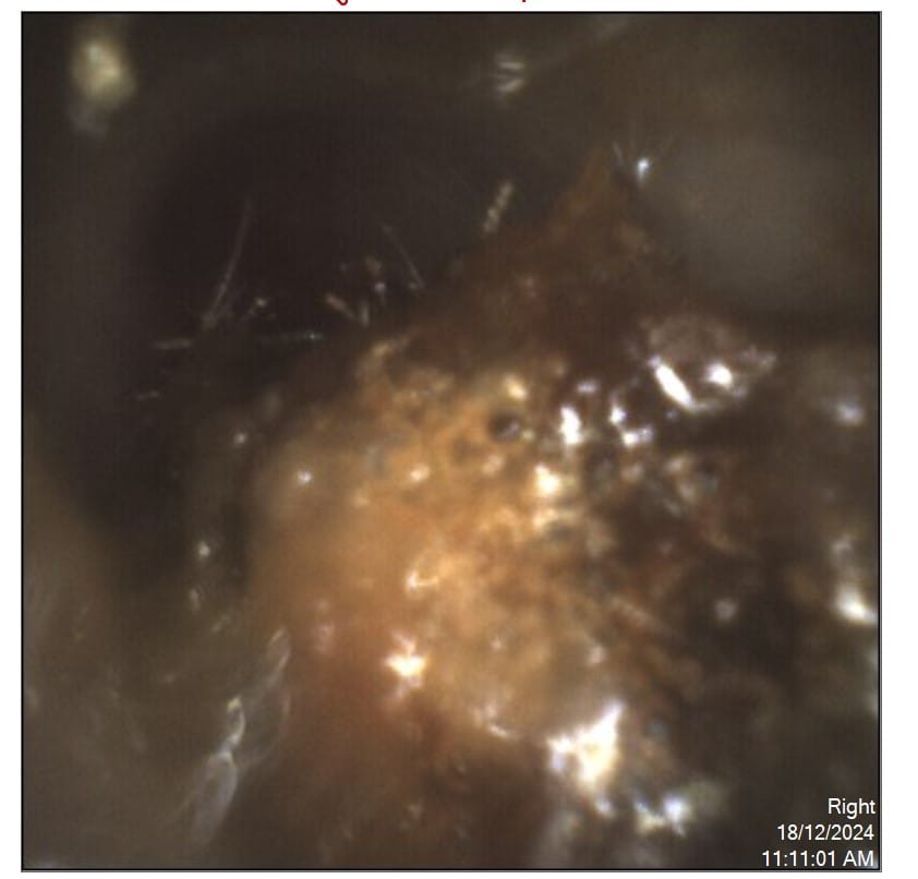 Before Wax Removal - The Audiology Place before wax removal services the audiology place