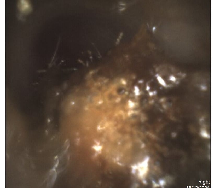  before wax removal ear wax removal before and after   the audiology place