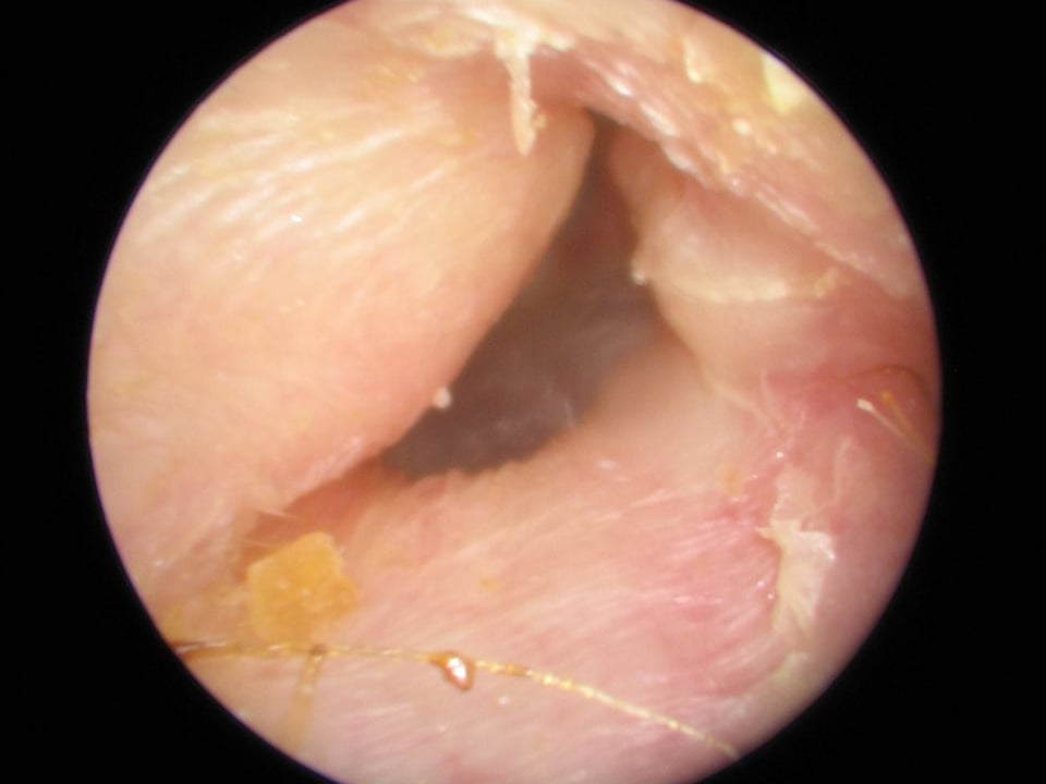 Exostoses - The Audiology Place exostoses surfers ear in neanderthals the audiology place