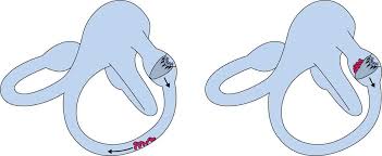 BPPV crystals - The Audiology Place bppv crystals benign paroxysmal positional vertigo bppv understanding the spinning sensation the audiology place