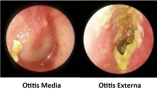  otitis media otitis externa otitis externa vs otitis media know the difference ear infection types   the audiology place