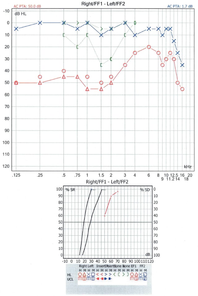 audiogram case study when a heavy ear isnt just wax the audiology place