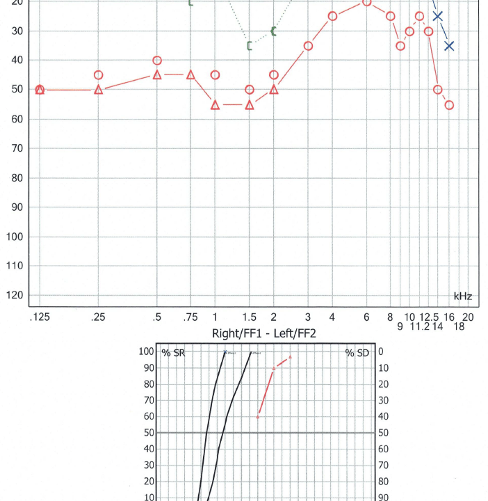  audiogram learn   the audiology place