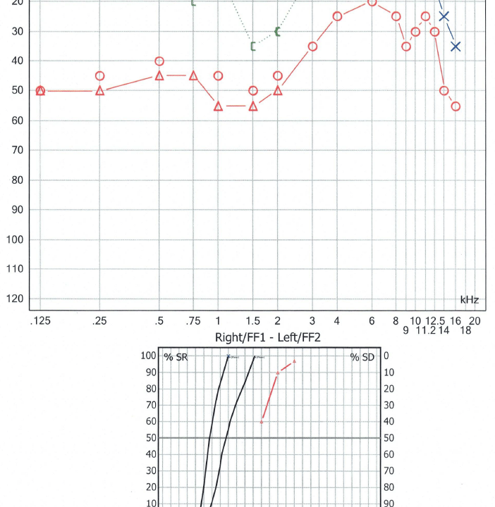 audiogram case study when a heavy ear isnt just wax the audiology place