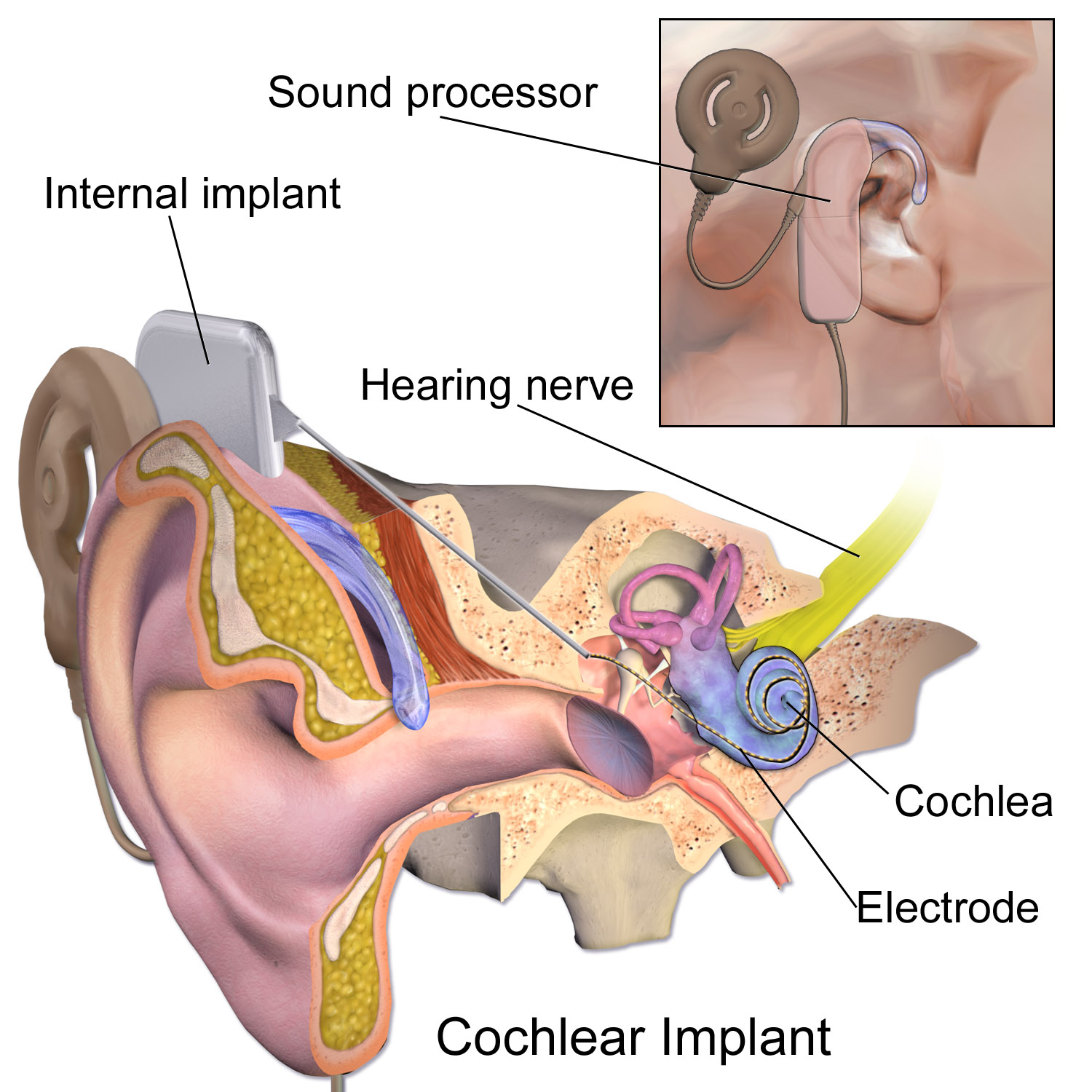  blausen 0244 cochlearimplant 01 cochlear implants   the audiology place