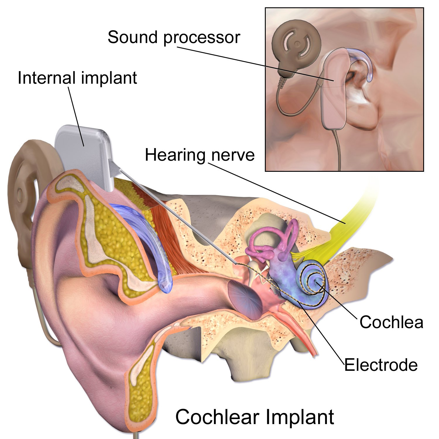 Blausen_0244_CochlearImplant_01 - The Audiology Place blausen 0244 cochlearimplant 01 cochlear implants the audiology place
