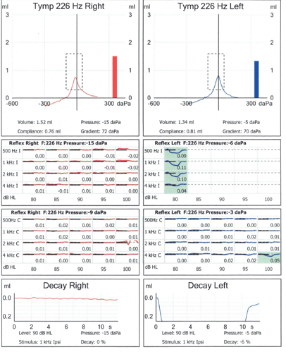  tymps case study when a heavy ear isnt just wax   the audiology place