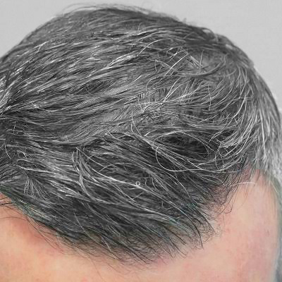 خالد النمر: الشيب المبكر قد يكون مؤشرًا صحيًا. دراسات تربط الشيب قبل الأربعين بزيادة خطر تصلب الشرايين. الإجهاد التأكسدي سبب محتمل يؤثر على الشعر وبطانة الشرايين. ليس تشخيصًا بل تنبيهًا لمراجعة عوامل #أمراض_القلب 