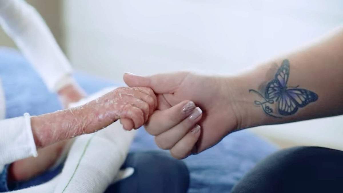 Fotografía cortesía de APEA que muestra las manos que pertenecen a dos personas distintas. La primera, a la izquierda, es una mano pequeña, con la piel descamada y llena de ampollas, que toma un dedo de la mano de una mujer, que lleva las uñas con manicure francés y en el brazo, tatuada, una mariposa azul. De fondo a ese apretón de manos se ven unas mantas color azul, como de cama de hospital.