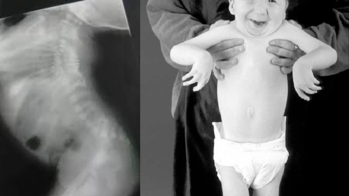Radiografía del torso de un recién nacido con la espalda arqueada hacia al frente.