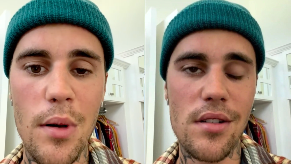 El cantante Justin Bieber con parálisis facial en la mitad izquierda de su rostro.