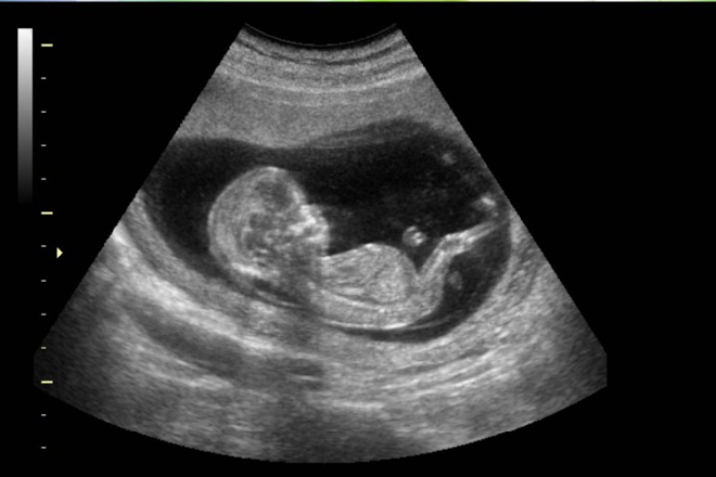 Ecografía de un bebé en el útero.