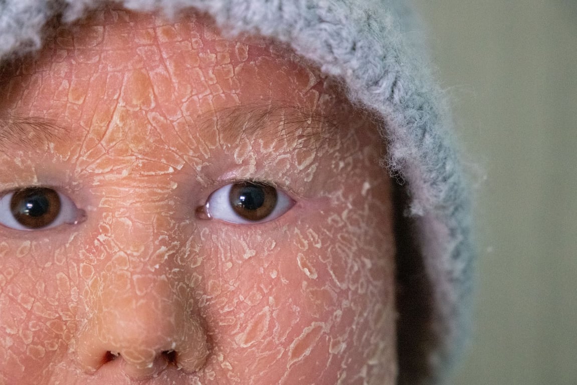 Ariadna López con la piel de su rostro descamada.