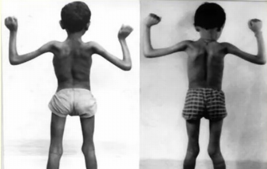 Niño con distrofia muscular se muestra de espaldas.