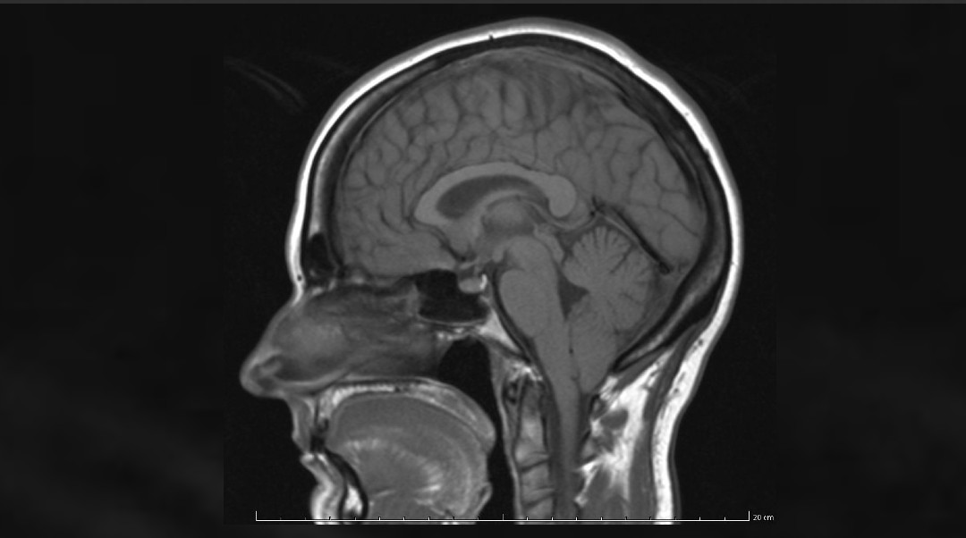 Radiografía de una persona con Síndrome de Arnold Chiari tipo I.