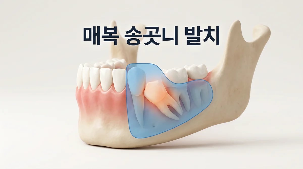 매복 송곳니 발치 수술: 진단부터 치료 과정까지 5단계 상세 가이드
