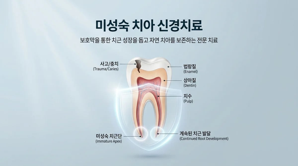 미성숙 영구치 신경치료 이해: 치아 뿌리 성장을 위한 보존 전략
