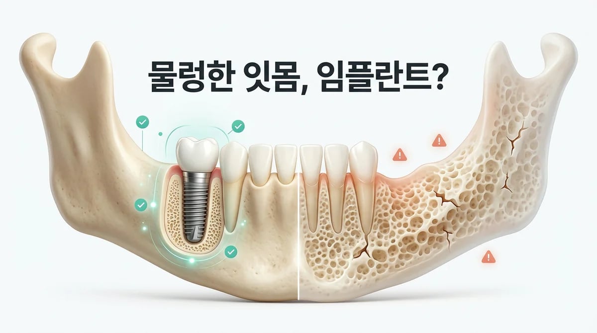 물렁한 잇몸, 임플란트 정말 가능할까요? 꼭 알아야 할 주의사항 5가지