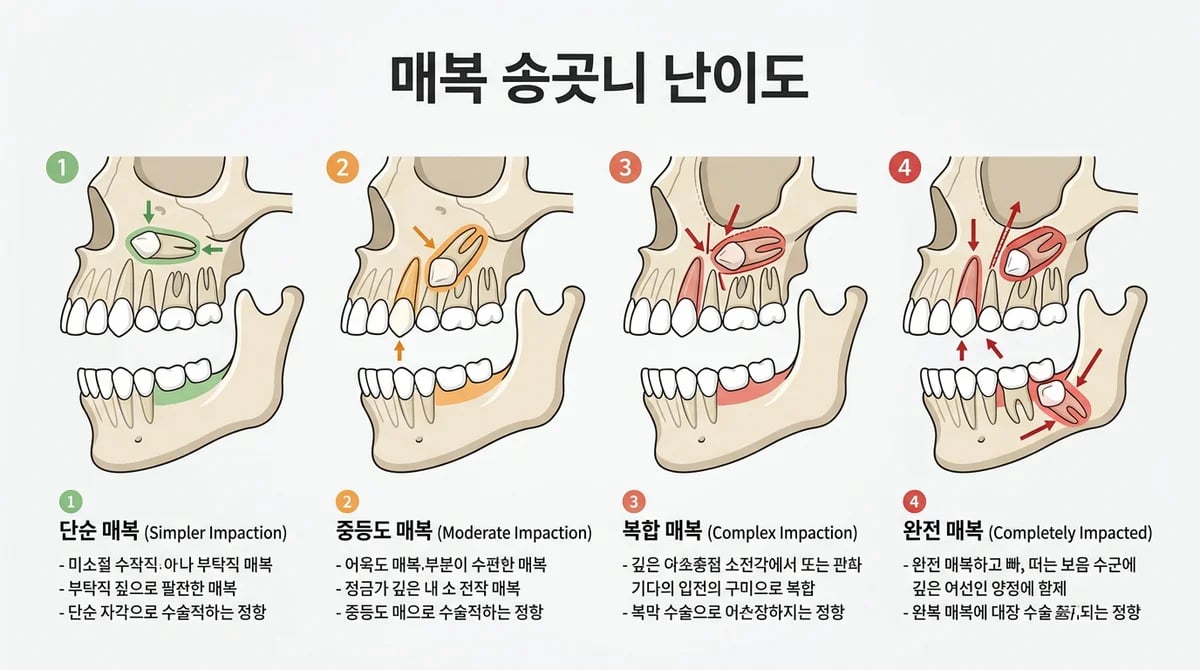 매복 송곳니 발치, 난이도 결정 5가지 핵심 요소와 고려사항