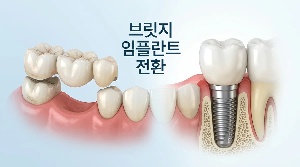 브릿지 지지치아 문제: 임플란트 전환 고려 시점과 과정