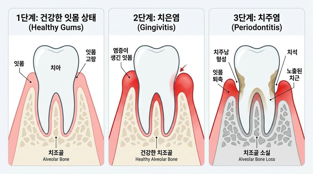 건강한 잇몸, 치은염, 치주염의 진행 단계를 보여주는 비교 도식