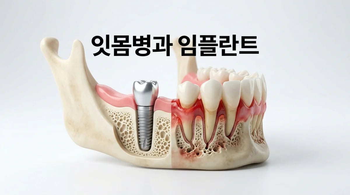 잇몸 질환으로 치아 상실 후 임플란트, 성공적인 시술을 위한 핵심 가이드