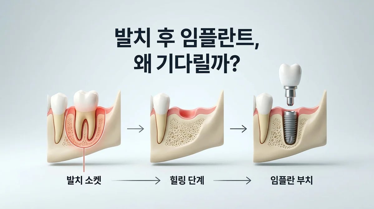 발치 후 임플란트, 왜 기다릴까요? 지연 식립의 과학적 이유와 시기