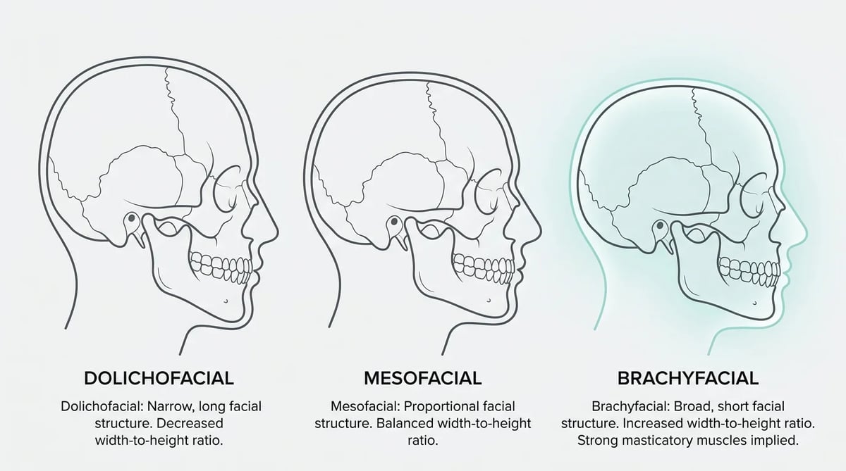단안모(Brachyfacial) 얼굴형과 과개교합의 연관성을 보여주는 얼굴 형태 비교 다이어그램