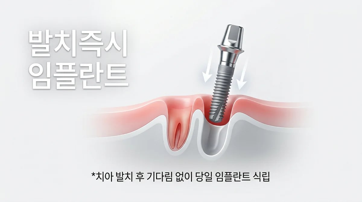 발치 즉시 임플란트 이해: 치료 기간 단축의 핵심 원리와 고려사항