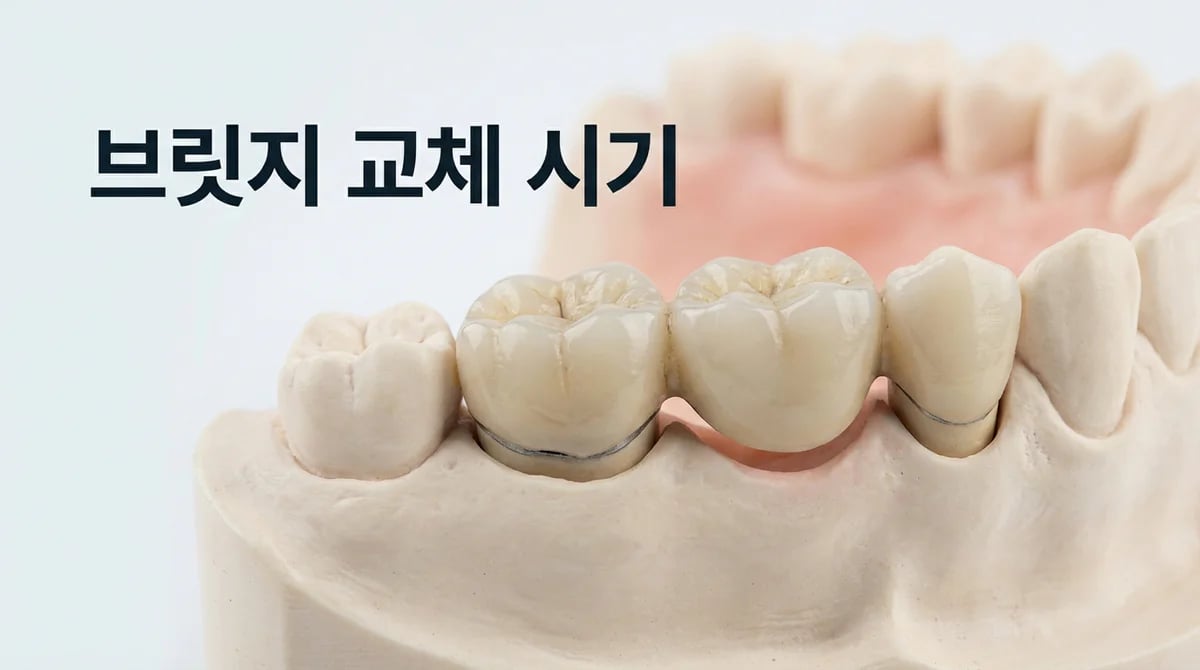 오래된 치아 브릿지, 언제 교체해야 할까요? 수명과 2차 충치 신호