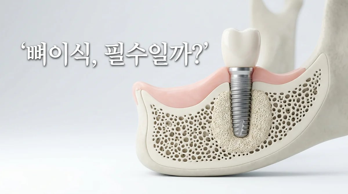 임플란트 뼈이식, 모든 경우에 필수적일까? 진단과 결정 가이드