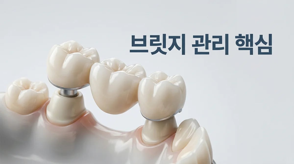 치과 브릿지 보철물, 장기적 수명 위한 구강 관리 핵심 팁