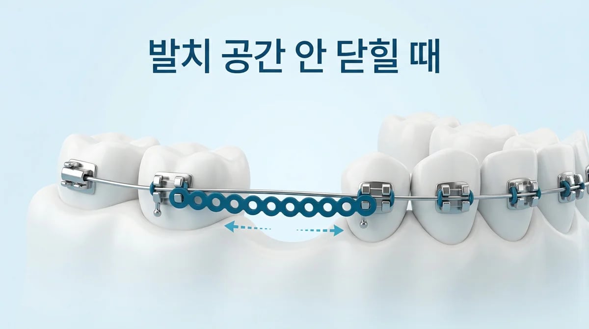교정 발치 공간 안닫힐 때: 3가지 핵심 원인과 효과적인 해결 방안