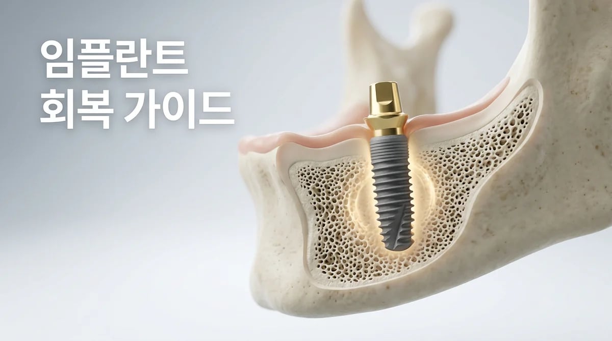 임플란트 식립 후 안정적인 회복을 위한 4단계 관리법