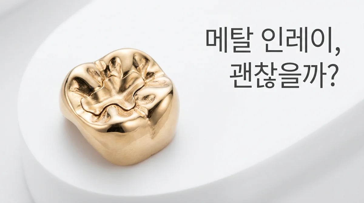 오래된 메탈 인레이, 치아 균열 원인과 3가지 고려사항