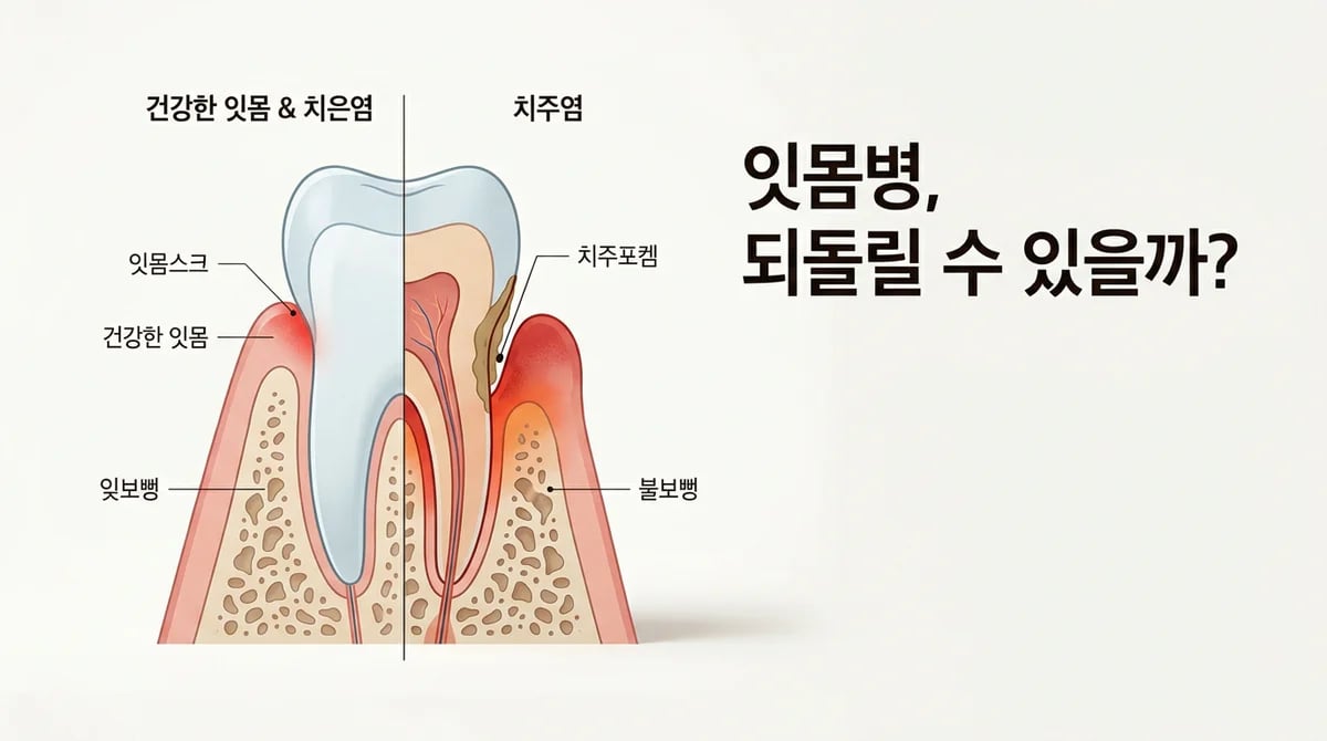 치은염과 치주염: 두 잇몸 질환의 명확한 차이점과 관리법