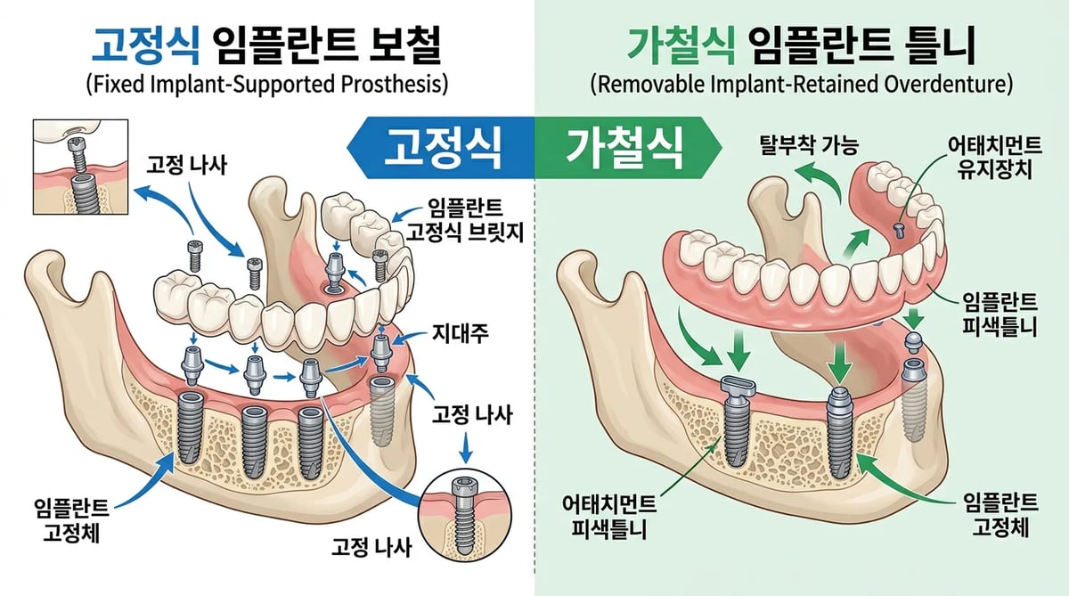 고정식 및 가철식 임플란트 보철물 비교 일러스트