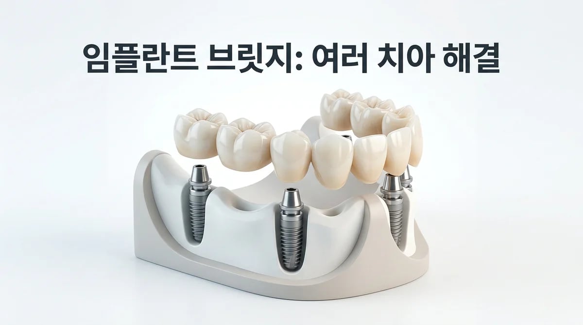 여러 치아 상실 시 임플란트 브릿지 가능성 및 성공 조건 가이드