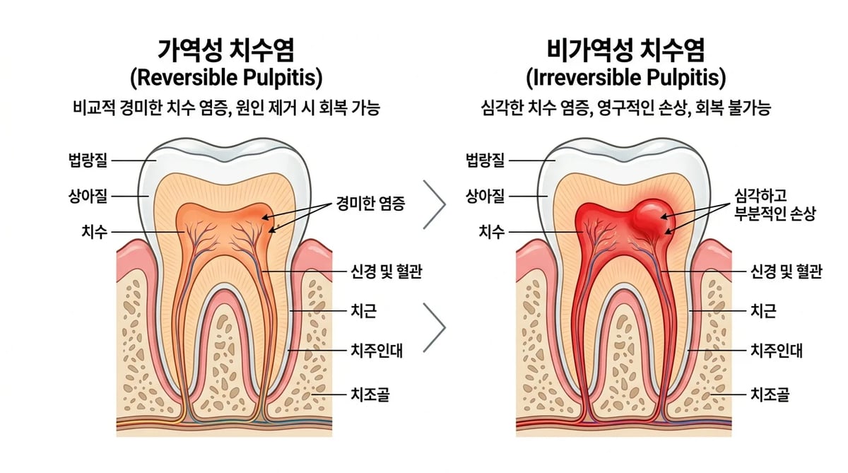 가역성 치수염과 비가역성 치수염의 차이를 보여주는 치과 인포그래픽