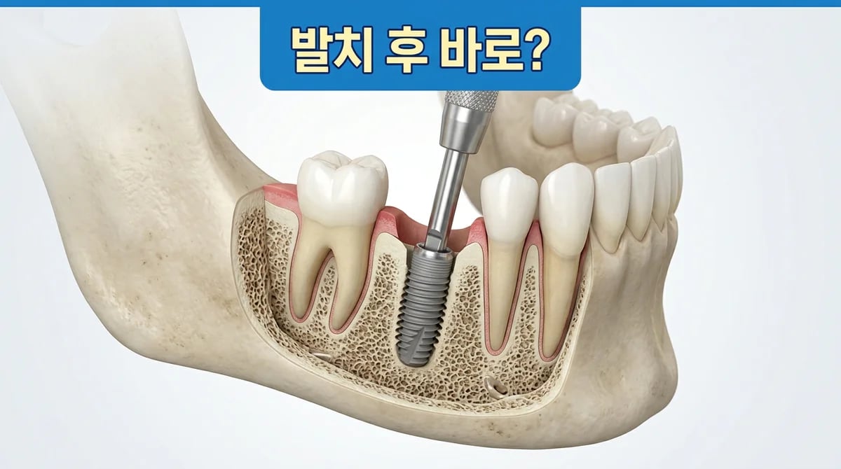 발치 후 즉시 임플란트: 성공을 위한 조건과 고려사항 5가지