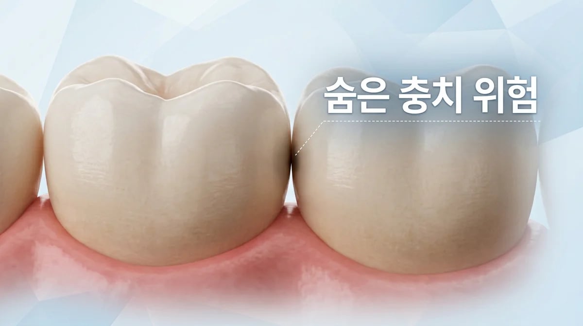 인접면 충치: 눈에 잘 띄지 않아 더 위험한 이유와 초기 증상 파악 가이드