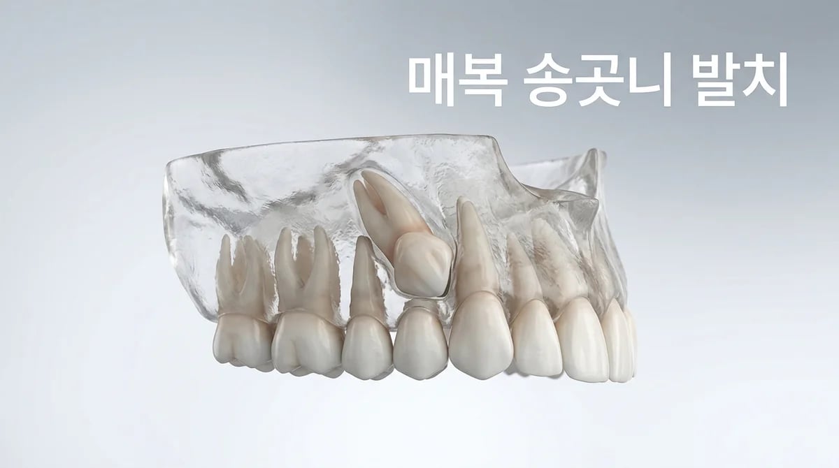 매복 송곳니 발치 수술: 정밀 진단부터 회복까지의 단계별 과정